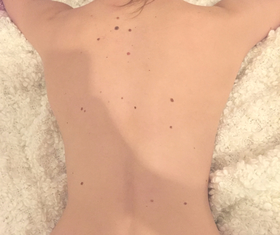 Muttermale lasern - Mein Rücken vor der Muttermalentfernung