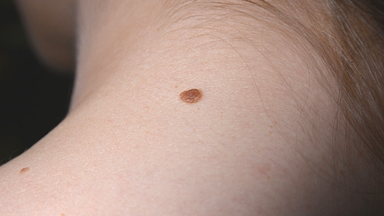 Muttermale entfernen lassen: Welche Methoden gibt es? 3 erhabenes20Muttermal1