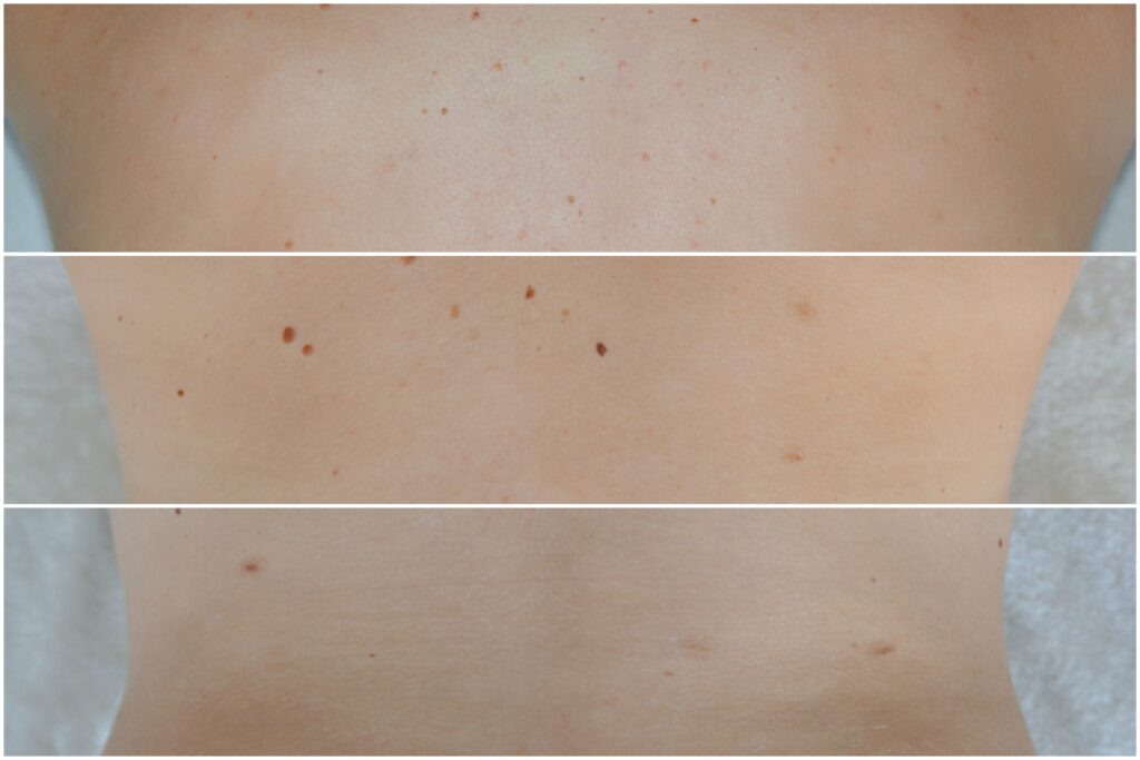 Update: Muttermale lasern I So sieht’s nach 2 Jahren aus 4 muttermal update 101