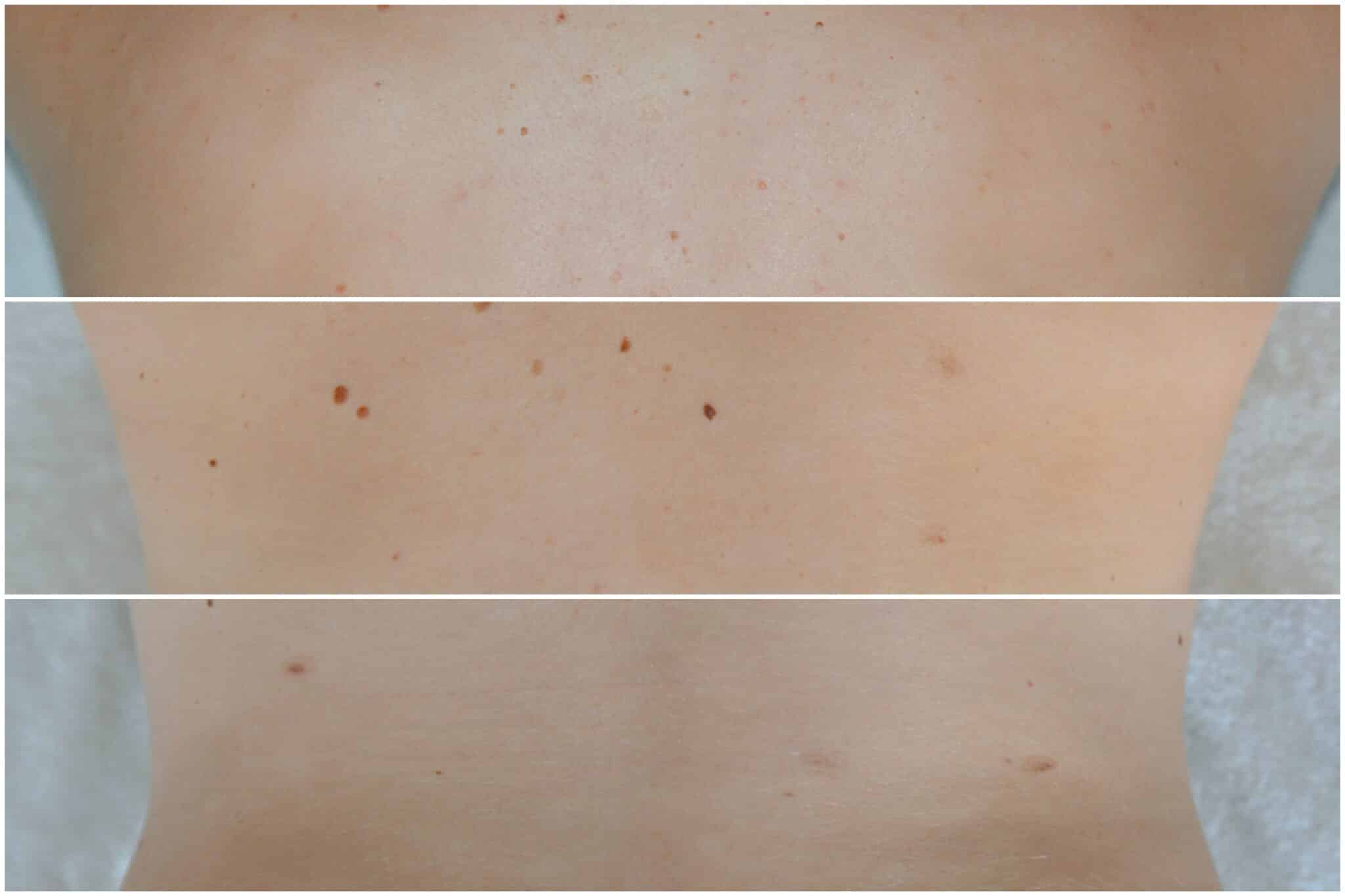 Update Muttermale lasern I So sieht’s nach 2 Jahren aus