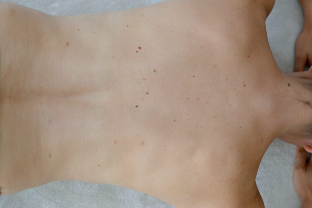 Update: Muttermale lasern I So sieht’s nach 2 Jahren aus 2 muttermal update 21