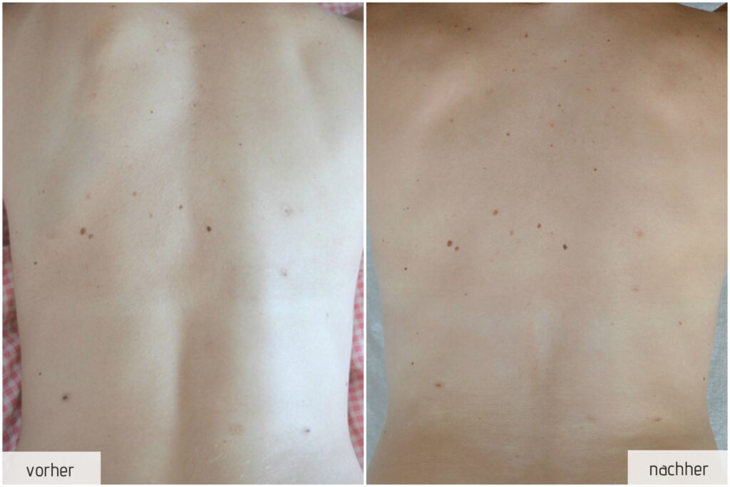Update: Muttermale lasern I So sieht’s nach 2 Jahren aus 3 muttermal update 91